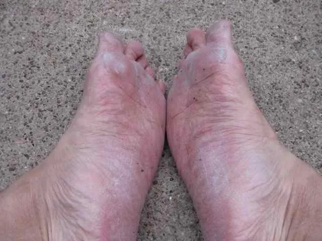 Soles of my two feet after barefoot run