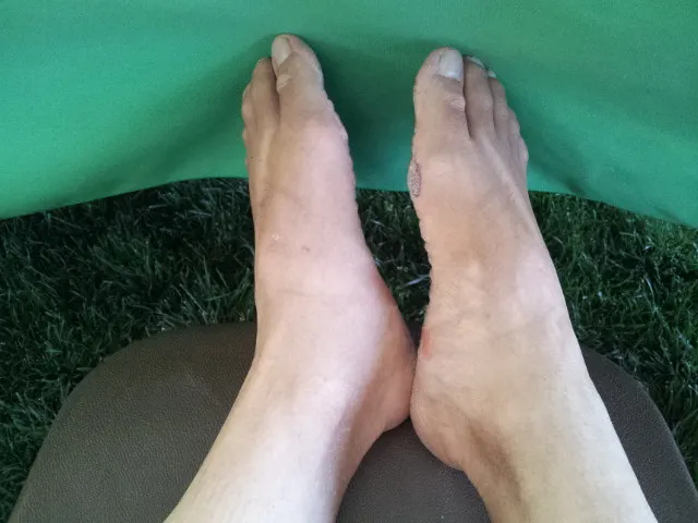 Blister on right foot