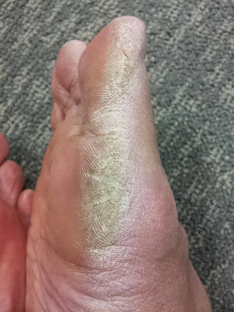 Right sole of foot