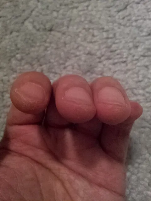 Ukulele calluses